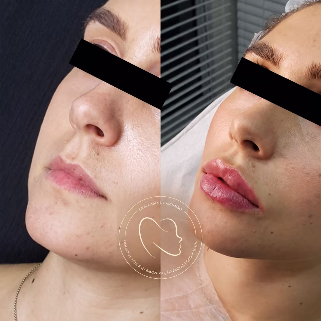 Antes e depois de preenchimento labial