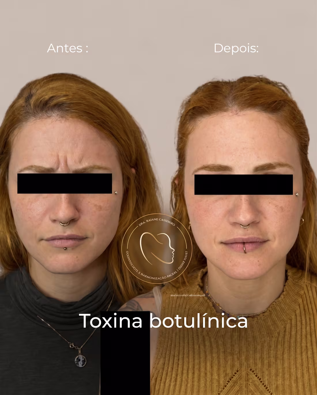 Antes e depois de toxina botulínica